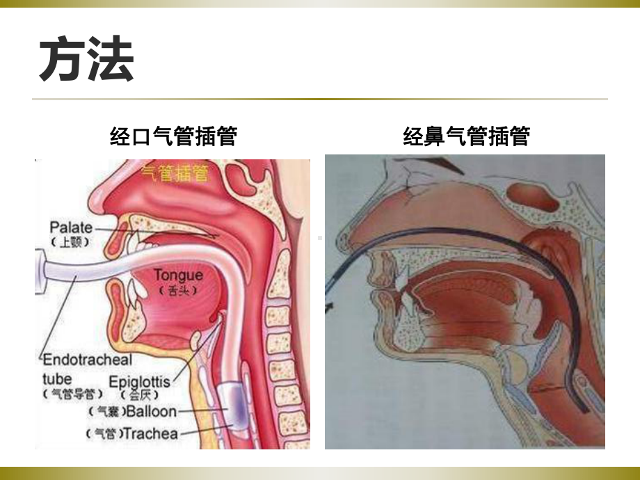 气管插管的护理课件.ppt_第3页