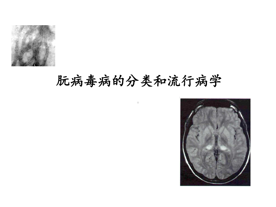 CJD临床诊断及监测.ppt_第3页