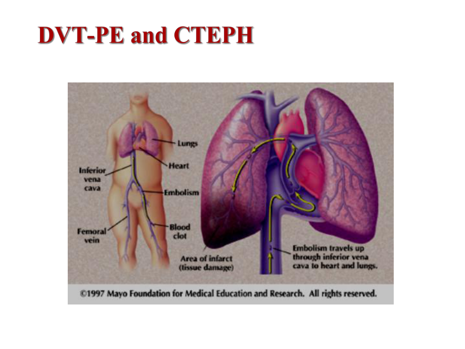 慢性血栓栓塞性肺动脉高压的病理生理学研究进展.ppt_第3页