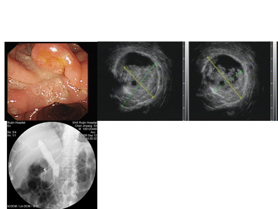 ERCP+IDUS诊治胰胆疾病.ppt_第3页