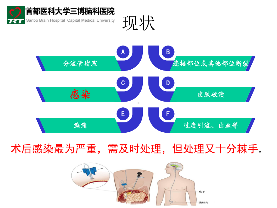 vp分流术后感染-医学资料.pptx_第2页