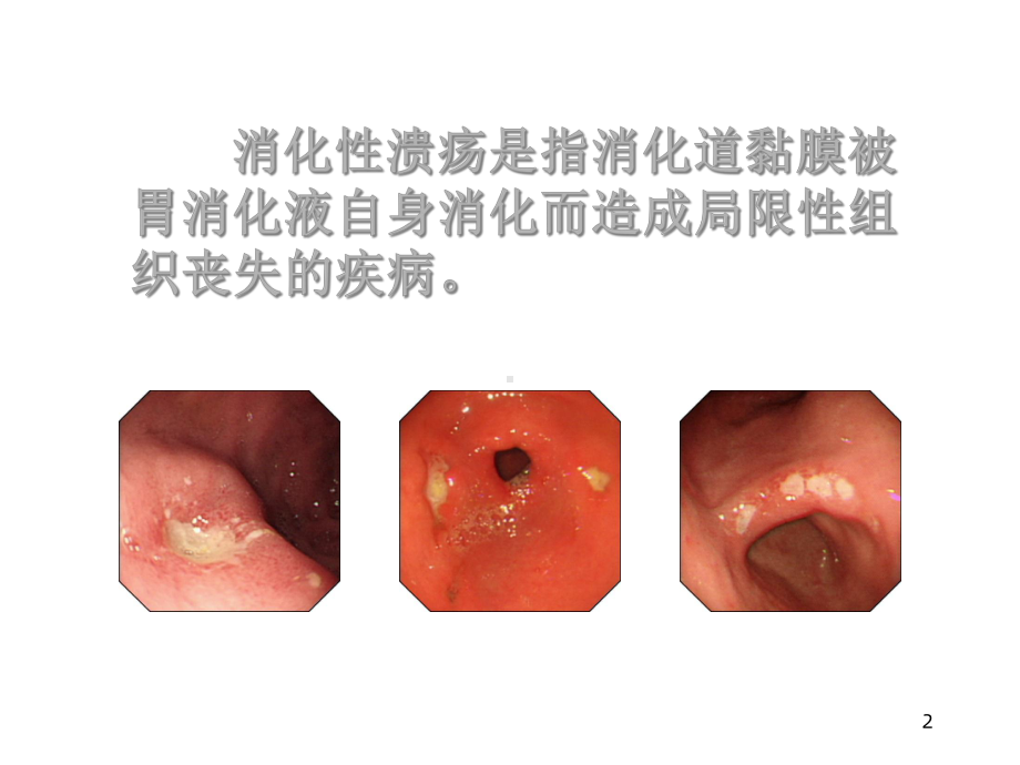 《小儿消化性溃疡》课件.ppt_第2页