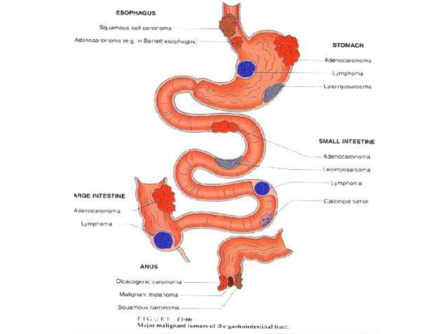 医学精品课件：10.消化系统肿瘤.ppt_第2页