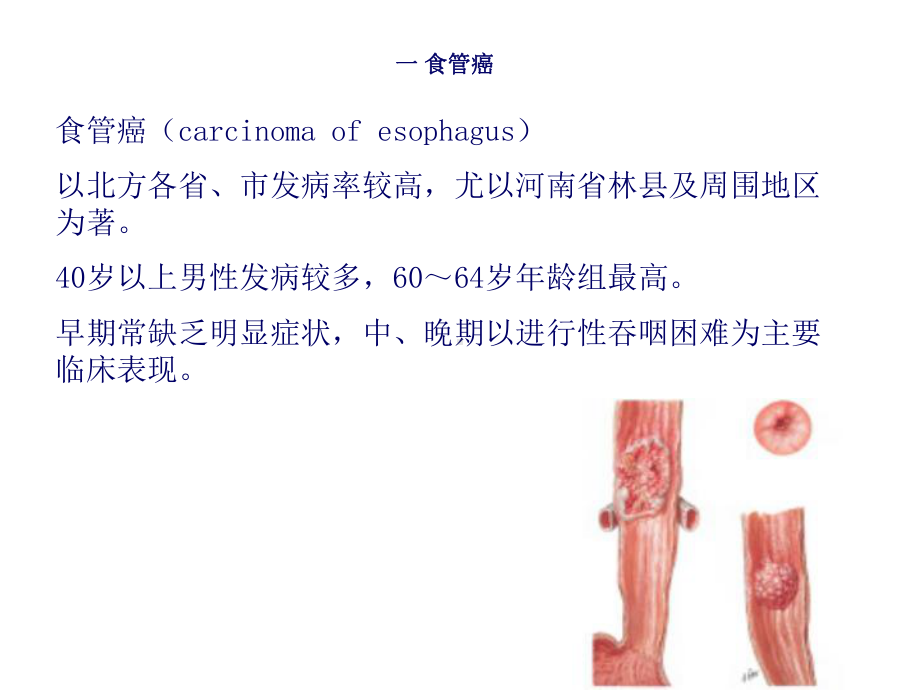 医学精品课件：10.消化系统肿瘤.ppt_第3页