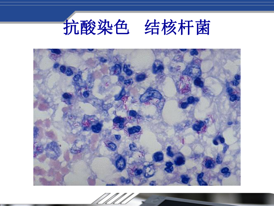 医学精品课件：结核.ppt_第3页