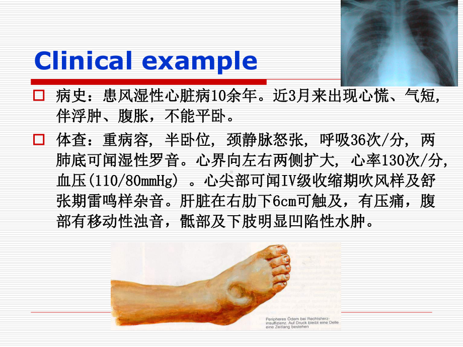 医学精品课件：心力衰竭-张常娥-2016,10.ppt_第2页