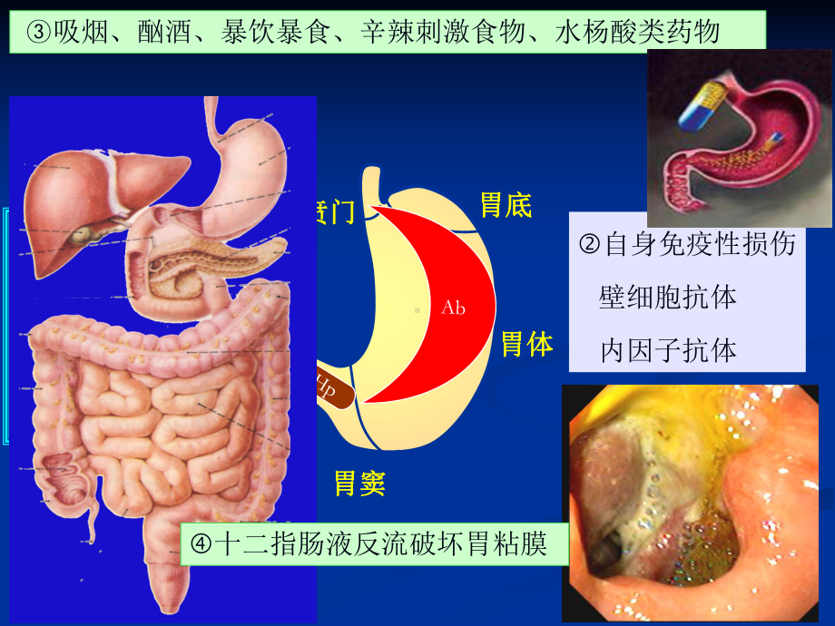 医学精品课件：胃炎、胃溃疡.ppt.ppt_第2页