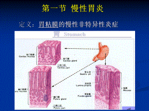 医学精品课件：胃炎、胃溃疡.ppt.ppt