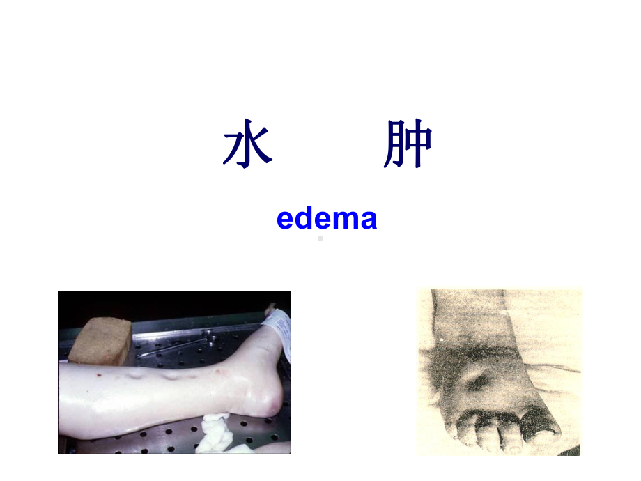 医学精品课件：3.水肿(8).ppt_第1页