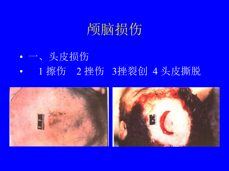 医学精品课件：04.机械性损伤3.1.ppt_第2页