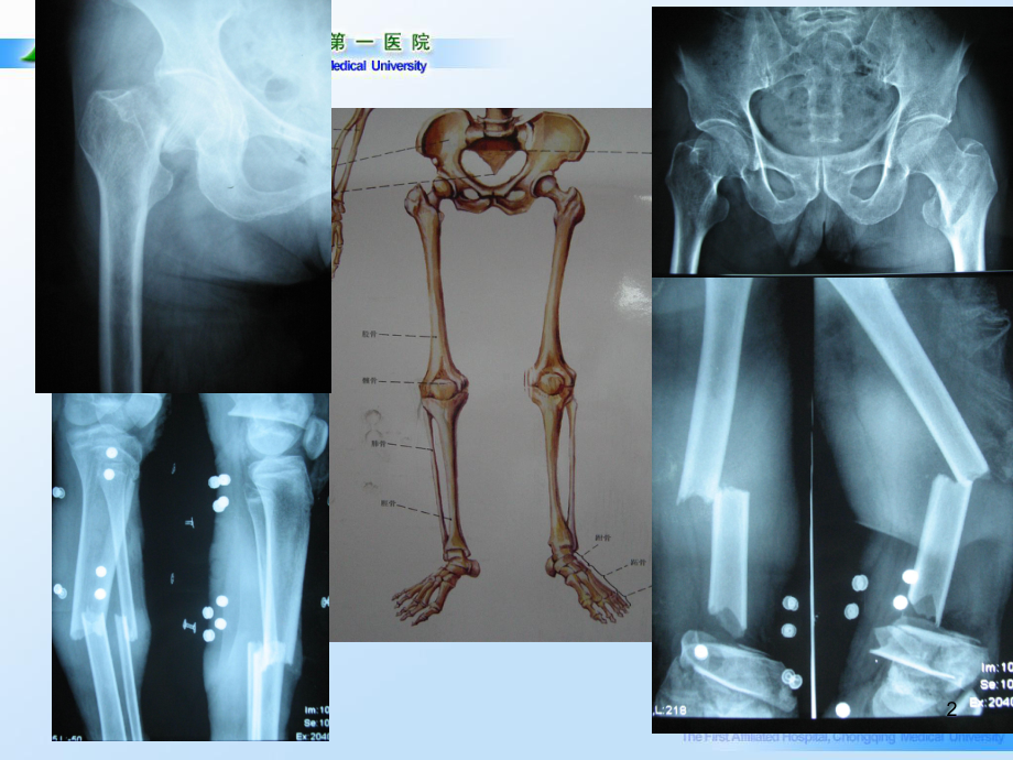 医学精品课件：04.下肢骨折-周爱国2017.ppt_第2页