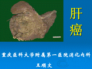 医学精品课件：16.1肝癌.ppt