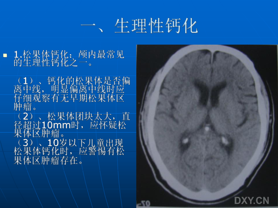 医学精品课件：关于颅内钙化.ppt_第2页