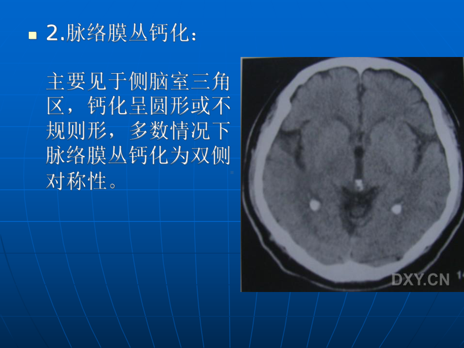 医学精品课件：关于颅内钙化.ppt_第3页