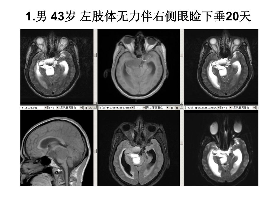 医学精品课件：垂体瘤的MR诊断与鉴别诊断.ppt_第2页