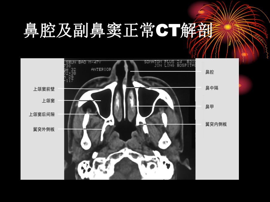 医学精品课件：鼻与鼻窦病变CT诊断.ppt_第2页