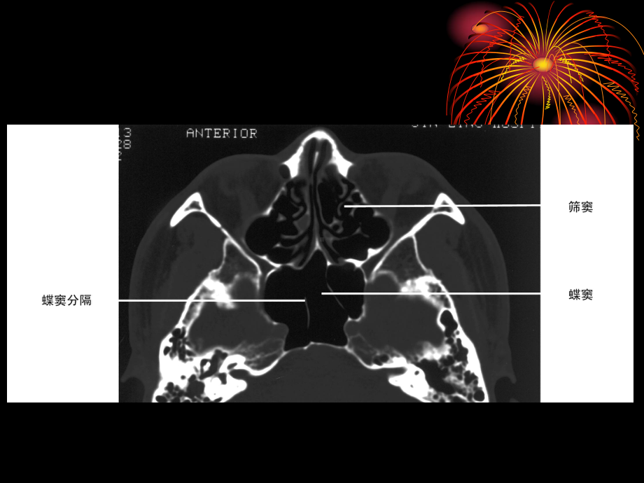 医学精品课件：鼻与鼻窦病变CT诊断.ppt_第3页