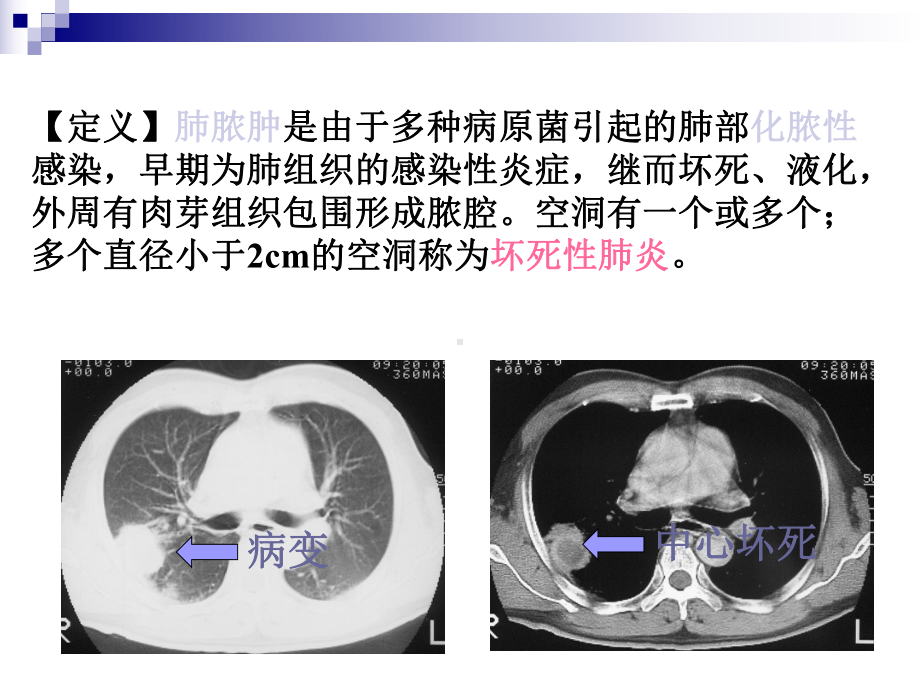 医学精品课件：肺脓肿.ppt_第3页