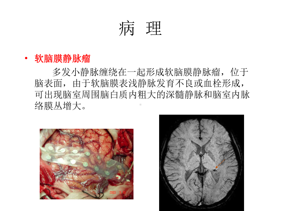 医学精品课件：Sturge-Weber syndrome.ppt_第3页