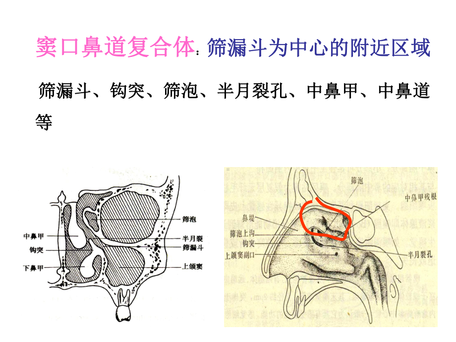 医学精品课件：鼻窦炎及并发症.ppt_第3页