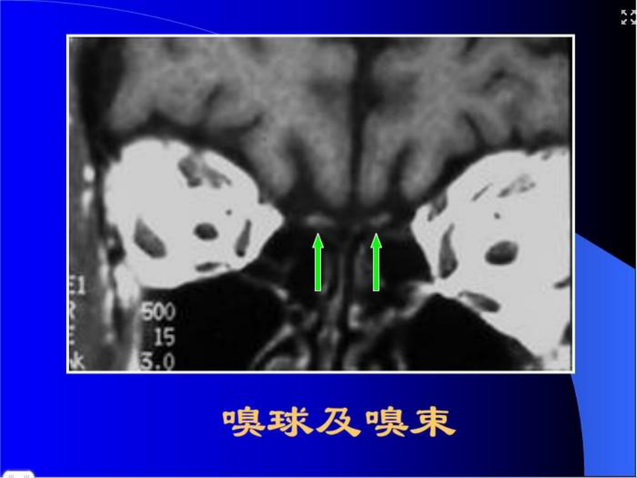 医学精品课件：各条颅神经清晰MRI影像.ppt_第3页