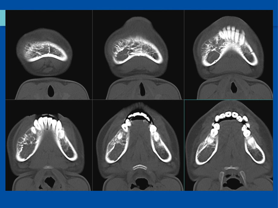 医学精品课件：颌骨中心性血管瘤.ppt_第3页