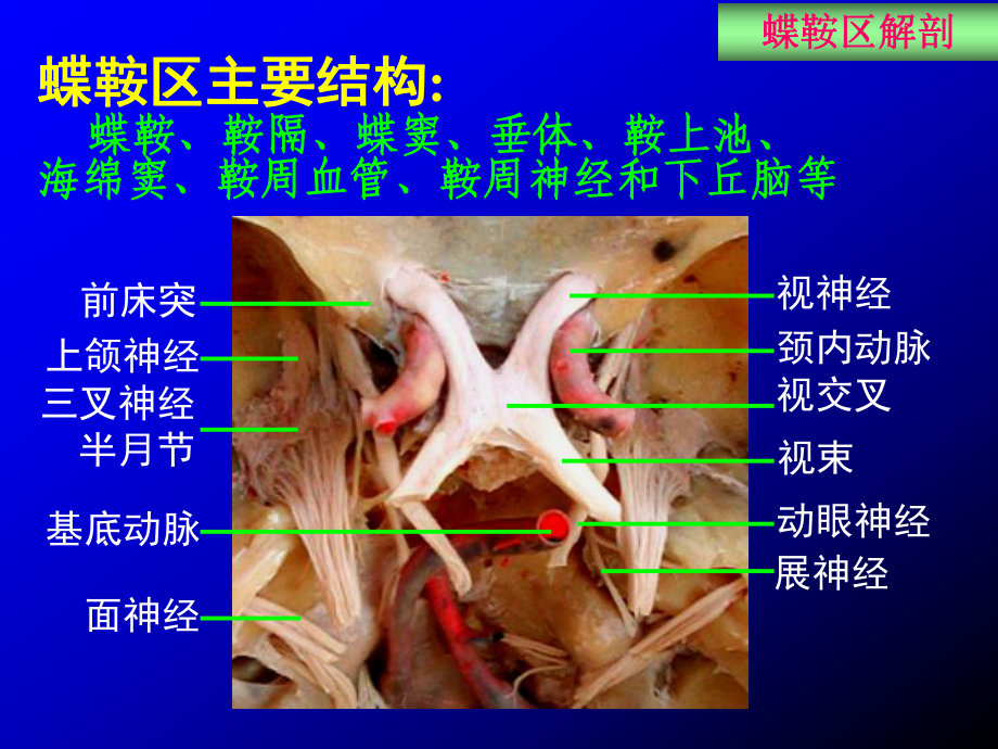 医学精品课件：蝶鞍区断层解剖与影像对照.ppt_第3页