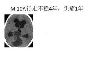 医学精品课件：毛细胞型星形细胞瘤随访.pptx