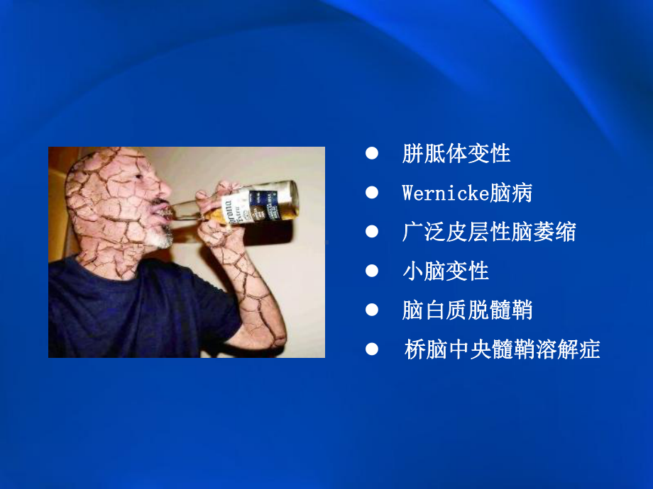 医学精品课件：酒精中毒性脑病影像学表现.pptx_第2页