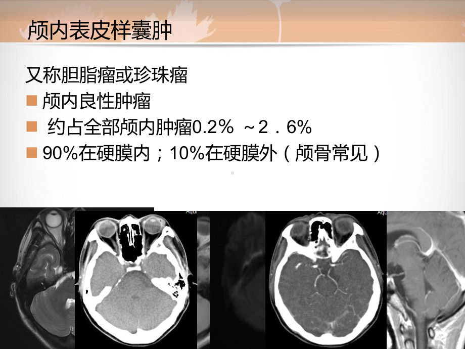 医学精品课件：颅骨表皮样囊肿随访.ppt_第2页