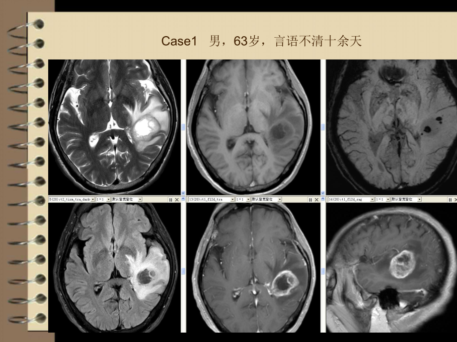 医学精品课件：混合性胶质瘤.ppt_第2页