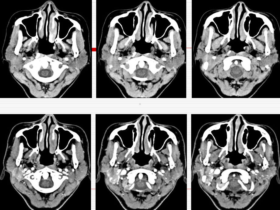 医学精品课件：颌面部相关神经病变的影像诊断.ppt_第3页