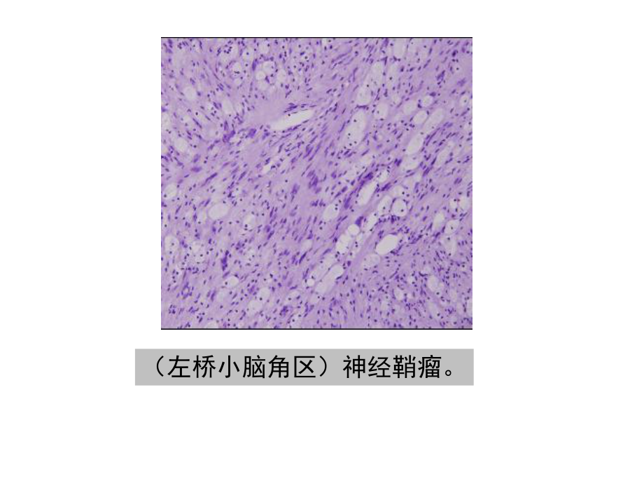 医学精品课件：桥小脑角区占位性病变病例.ppt_第3页