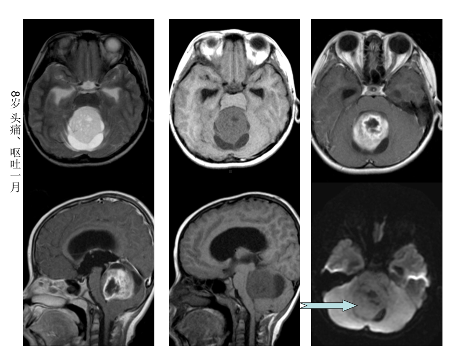 医学精品课件：脑肿瘤影像学.ppt_第3页