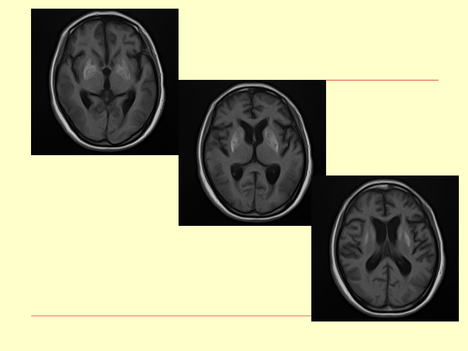 医学精品课件：颅脑MR影像诊断.ppt_第3页