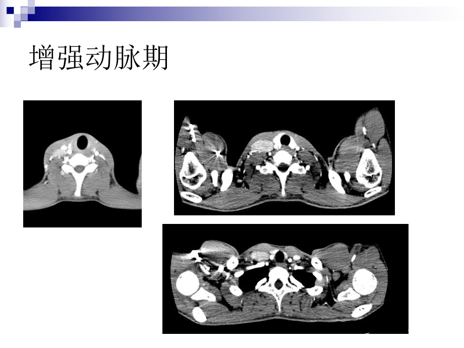 医学精品课件：颈部血管瘤与血管畸形.ppt_第3页