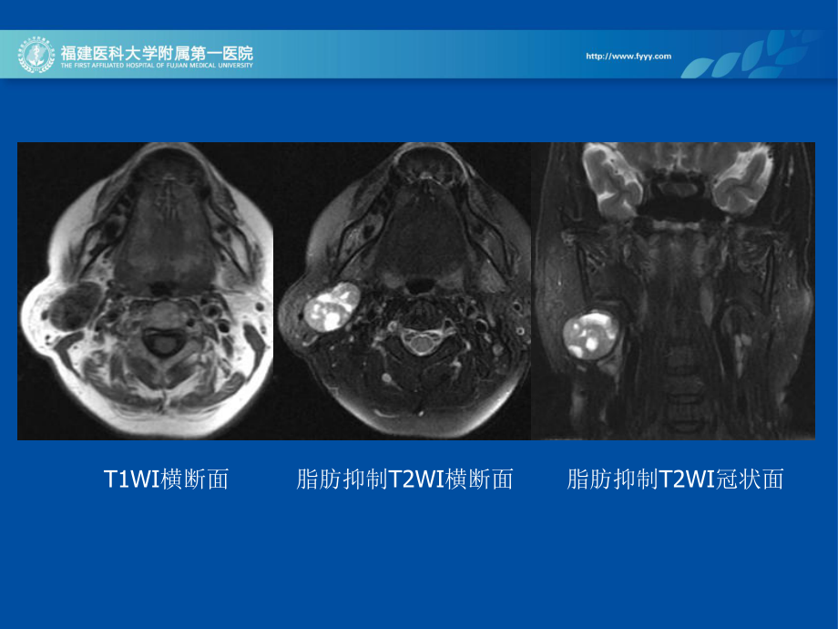 医学精品课件：腮腺基底细胞腺瘤全国口腔病例讨论最终稿(14-10-11).ppt_第3页