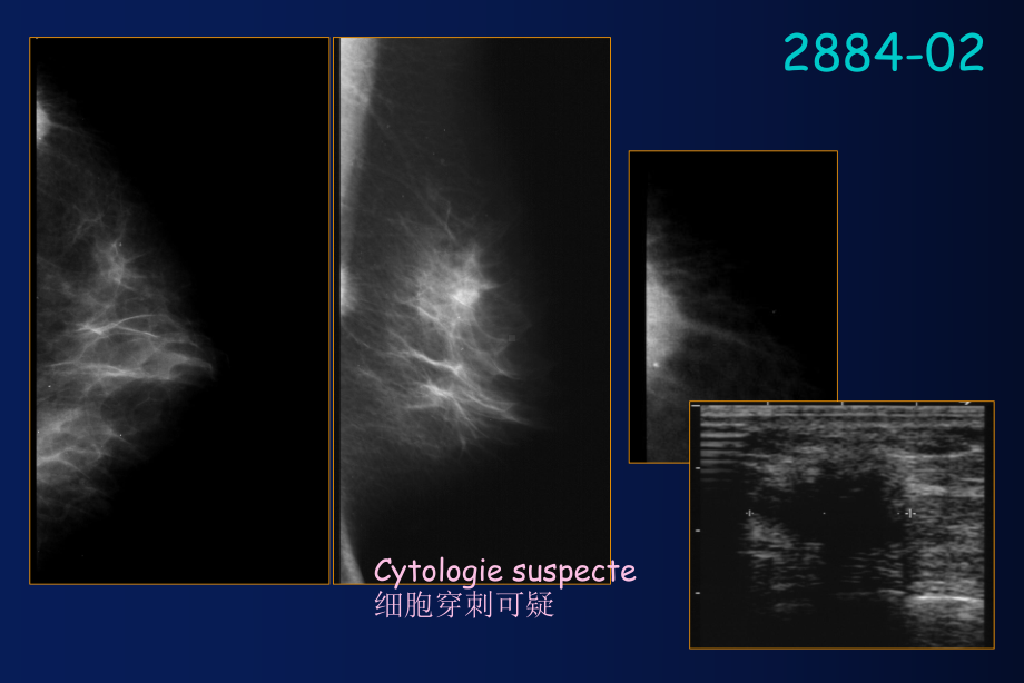 医学精品课件：乳腺影像难点及罕.ppt_第3页