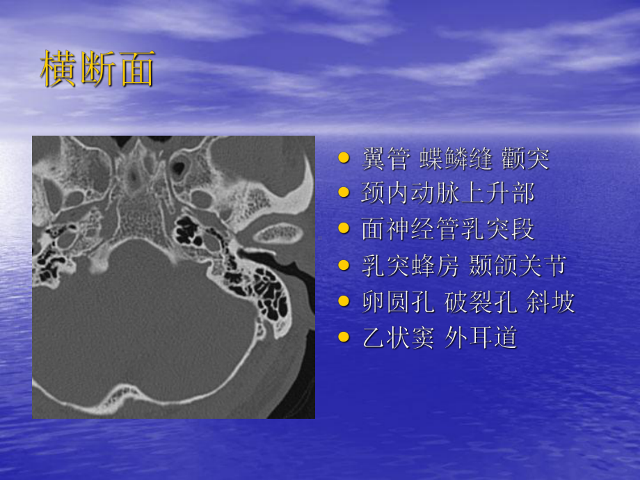 医学精品课件：颞骨CT影像解剖.ppt_第3页