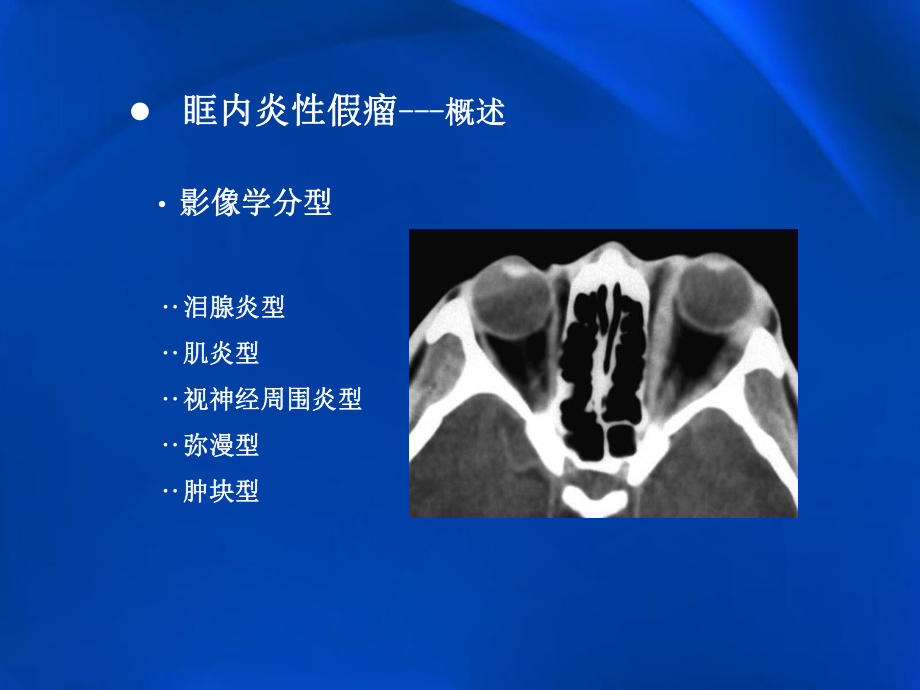 医学精品课件：眶内炎性假瘤影像学.pptx_第3页