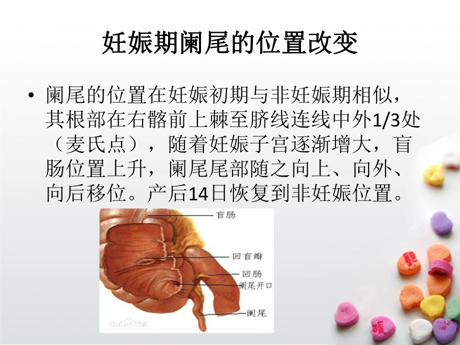 医学精品课件：妊娠合并急性阑尾.ppt_第3页