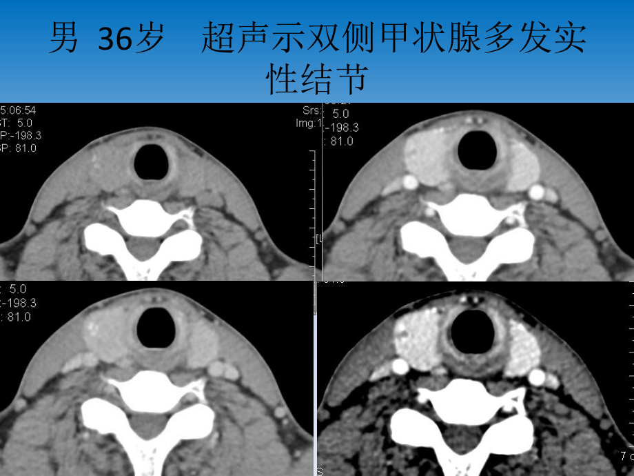 医学精品课件：甲状腺癌的CT诊断.pptx_第1页