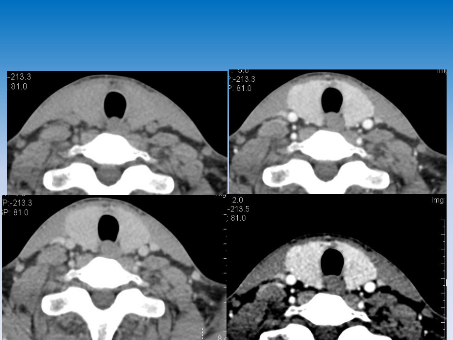 医学精品课件：甲状腺癌的CT诊断.pptx_第2页