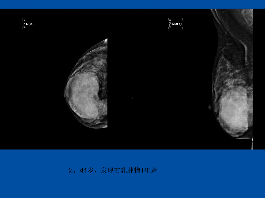 医学精品课件：乳腺叶状肿瘤影像表现.ppt_第1页