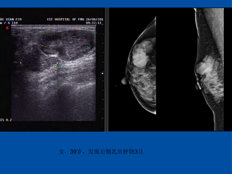 医学精品课件：乳腺叶状肿瘤影像表现.ppt_第2页