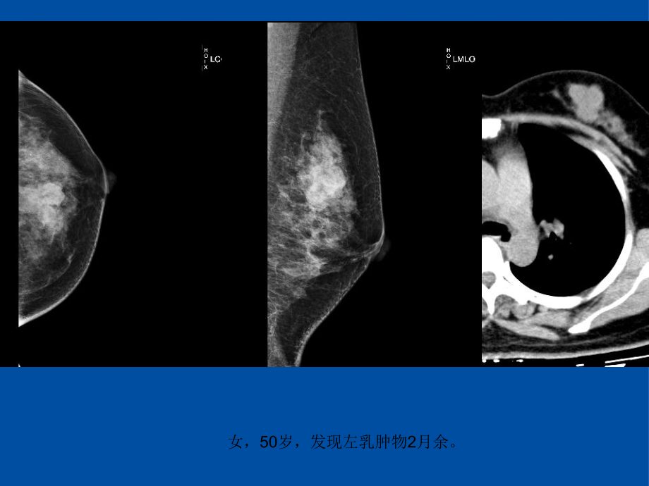 医学精品课件：乳腺叶状肿瘤影像表现.ppt_第3页