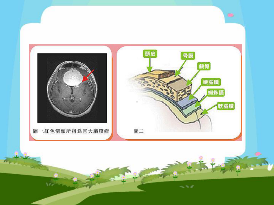 医学精品课件：脑膜瘤.ppt_第3页