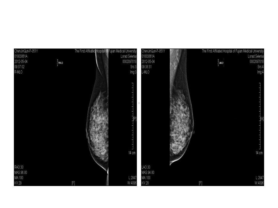 医学精品课件：乳腺病例.ppt_第2页