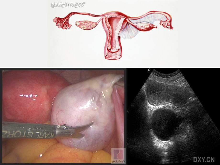医学精品课件：卵巢肿瘤.ppt_第3页
