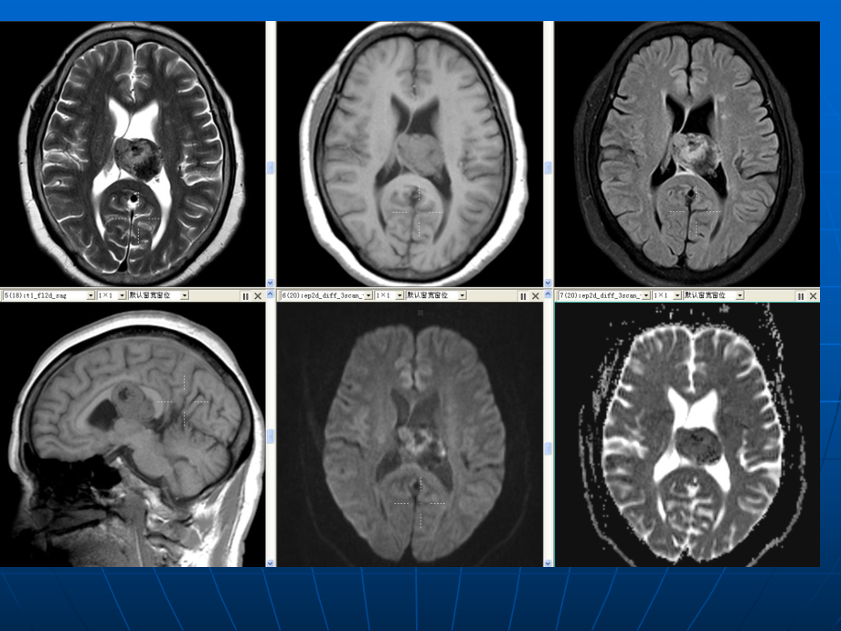 医学精品课件：脑室内肿瘤病例随访4例.ppt_第3页